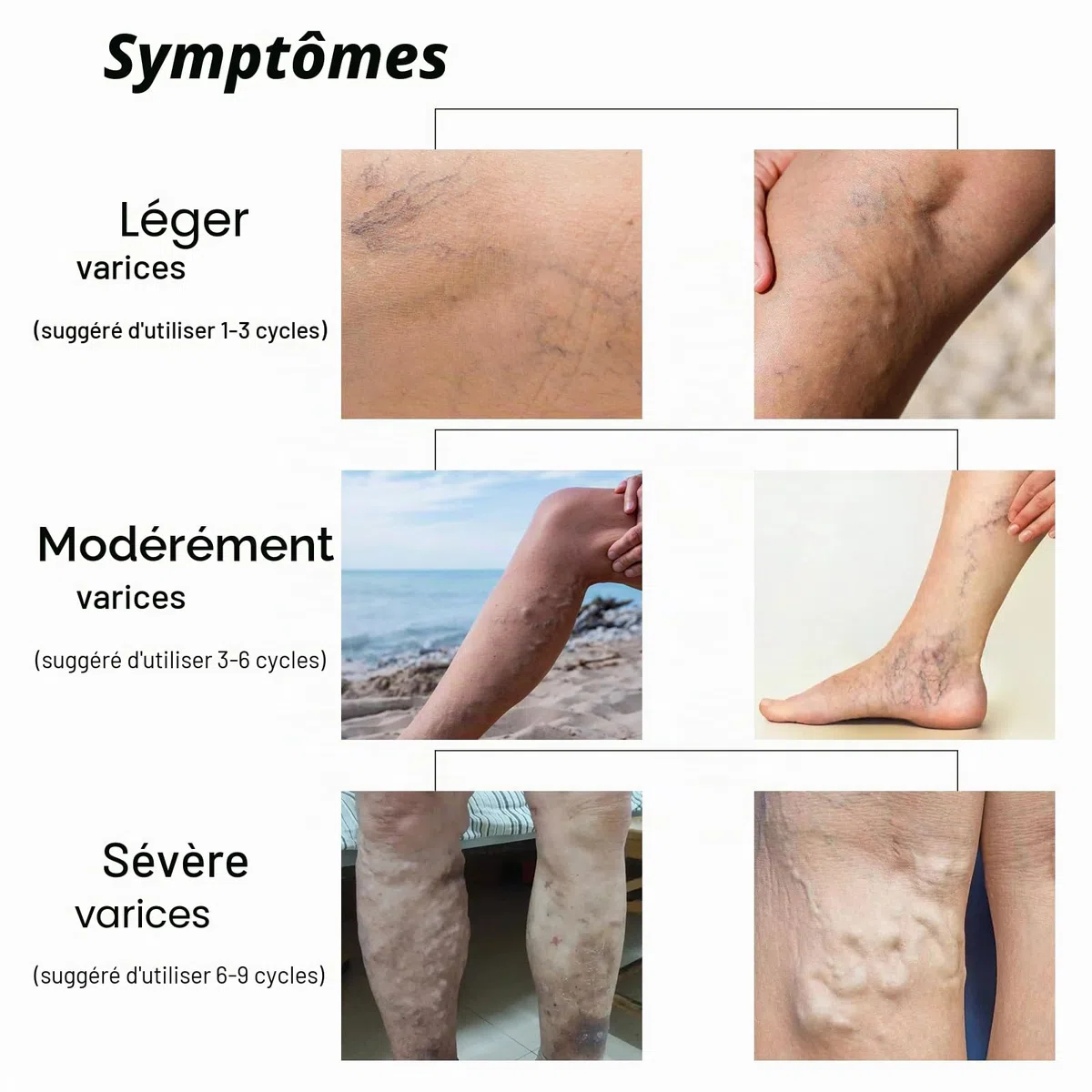 Crème anti-varices, anti-varices, anti-varicosités, soin doux des jambes, pour une bonne sensation dans les jambes, pommade de soin des jambes améliorant la circulation sanguine pour les jambes