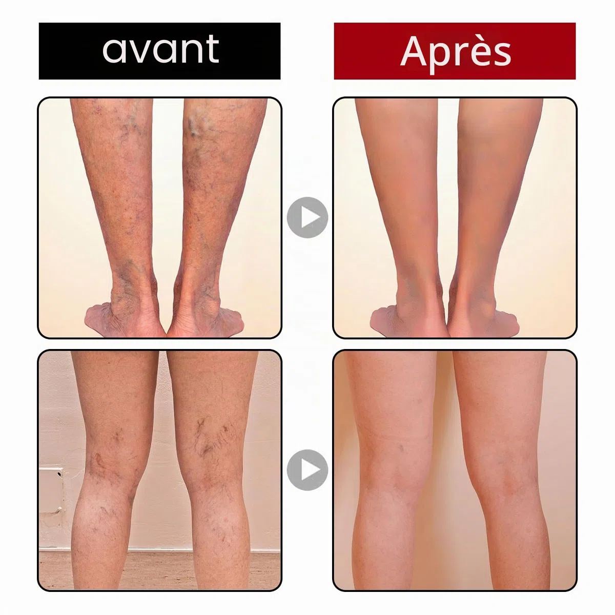 Crème anti-varices, anti-varices, anti-varicosités, soin doux des jambes, pour une bonne sensation dans les jambes, pommade de soin des jambes améliorant la circulation sanguine pour les jambes